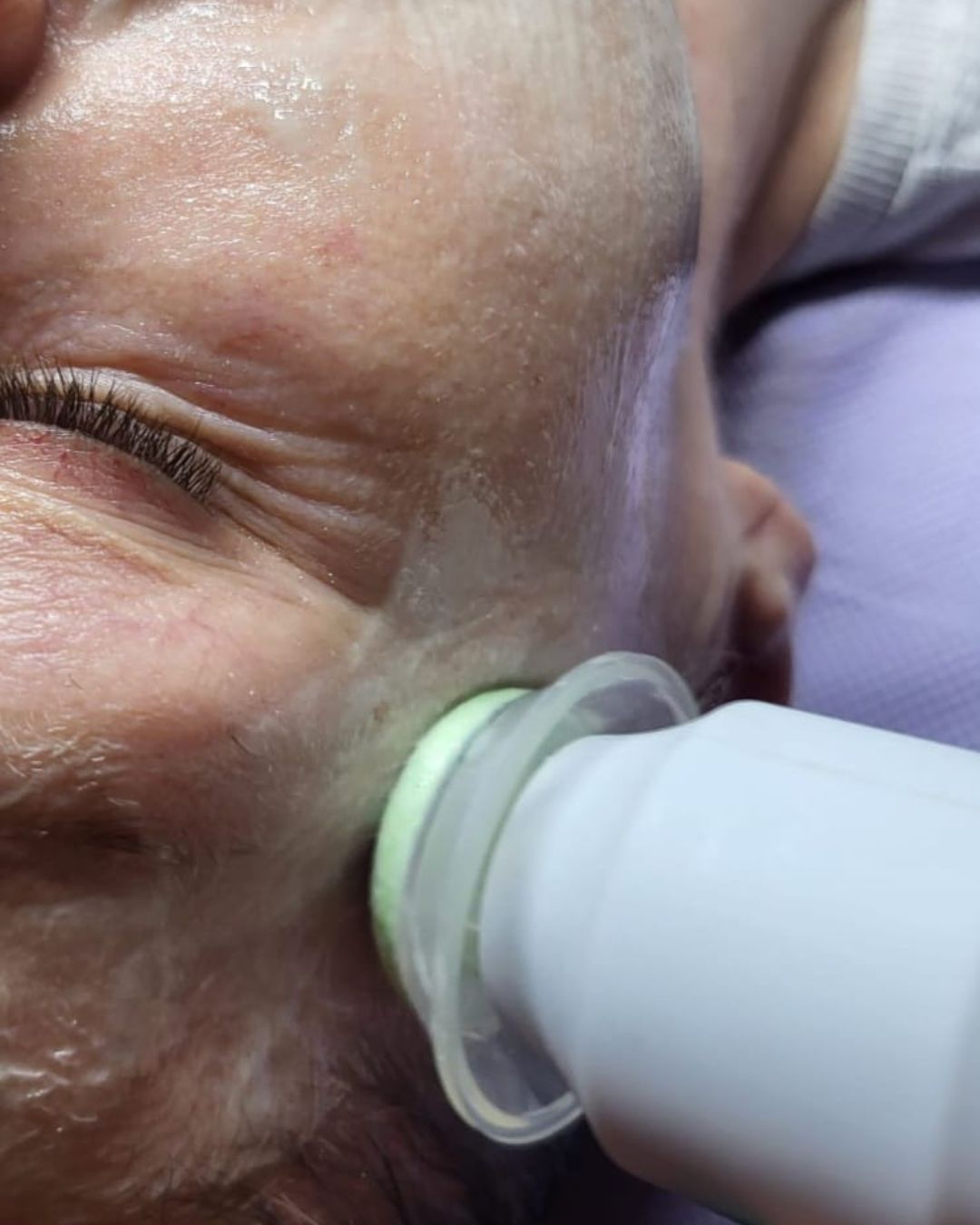 Oczyszczanie twarzy urządzeniem kosmetycznym.